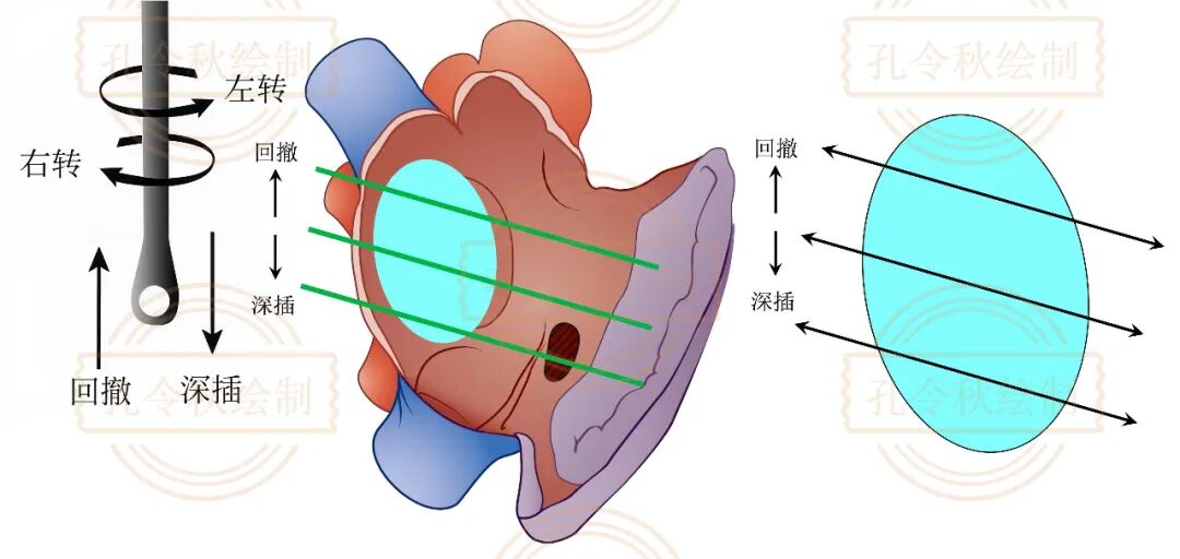 房间隔缺损大小，到底如何测量？