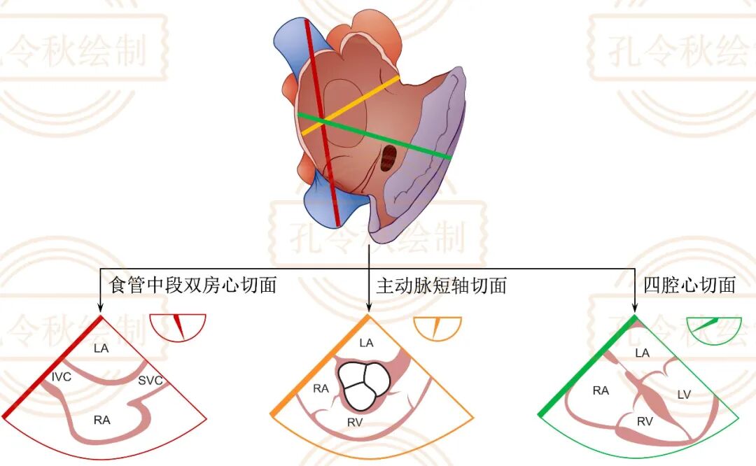 房间隔缺损大小，到底如何测量？