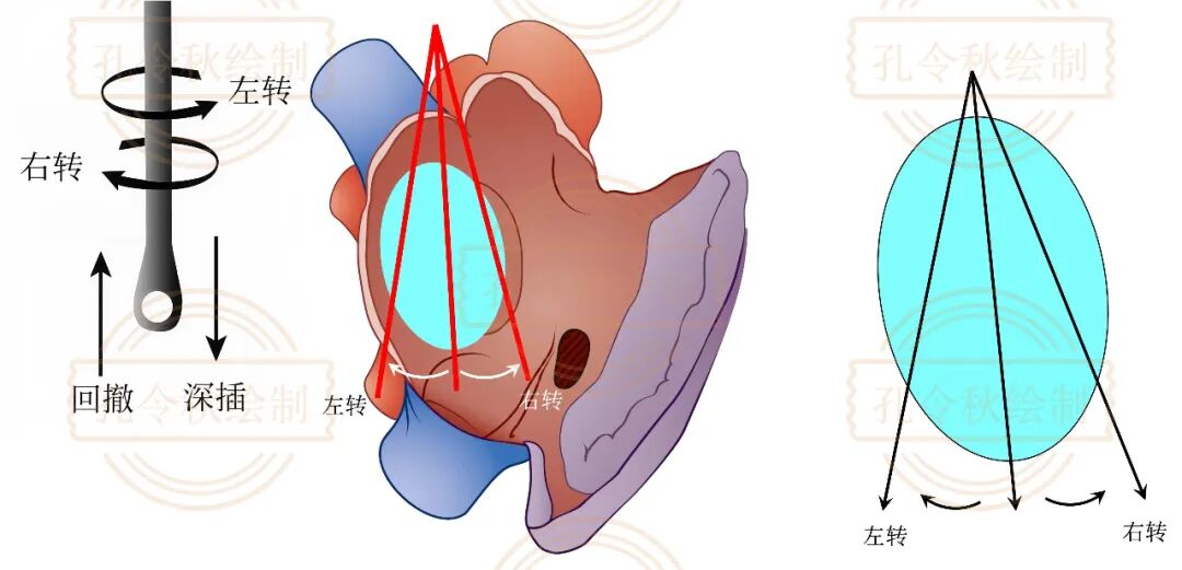 房间隔缺损大小，到底如何测量？