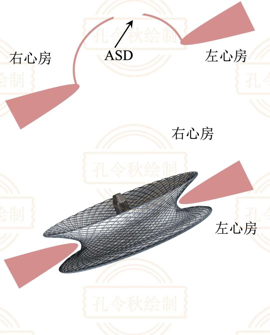 房间隔缺损大小，到底如何测量？