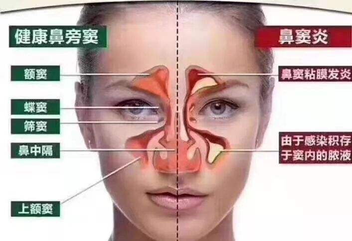 不要小看鼻窦炎，并发症直接危害生命！