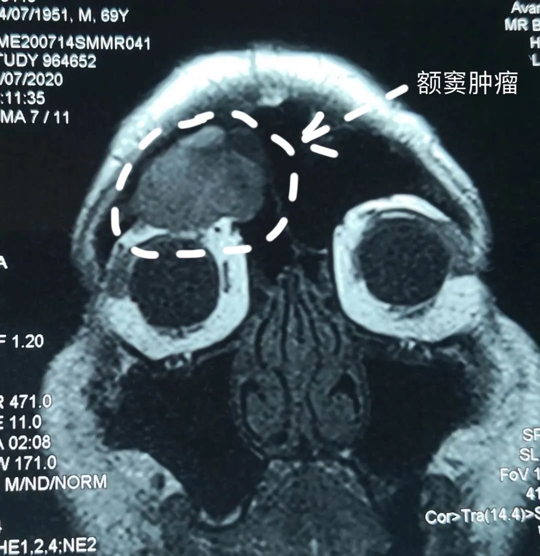 一项病例对照研究发现,吸烟会增加患鼻窦癌的风险,重度或长期吸烟者的