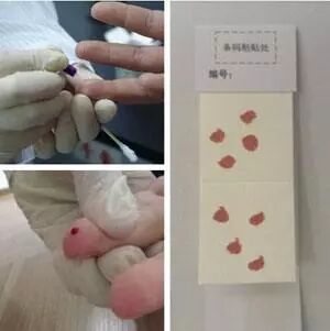 做无创胎儿亲子鉴定男方不方便到现场，采集什么样本最方便？