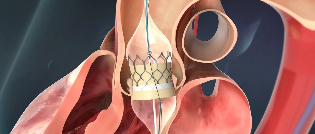 重磅｜启明医疗新一代球扩干瓣 Venus Vitae 全球首两例临床应用