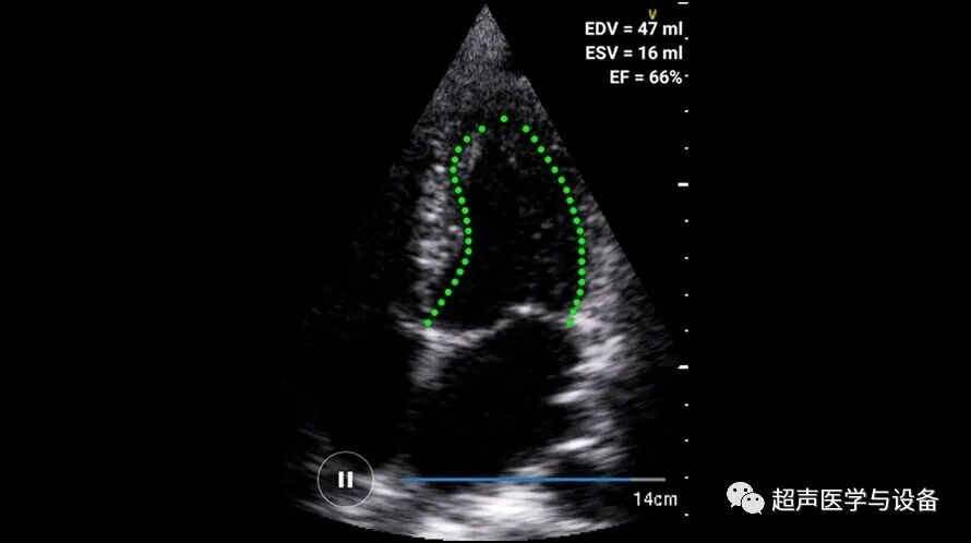 索诺星超声怎么样【一文盘点】市场主流掌上超声_https://www.jmylbn.com_新闻资讯_第12张