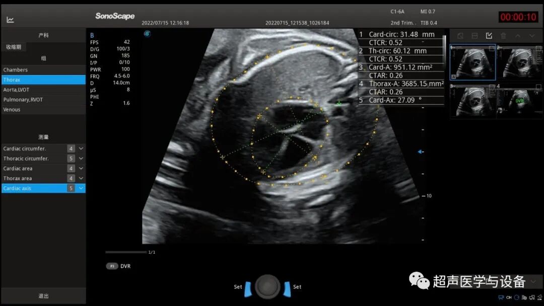 开立超声怎么导出图像借我一双“凤眼”，用AI把产筛纷扰看得真真切切---那个高老师探究彩超功能系列之开立S-Fetus4.0凤眼篇_https://www.jmylbn.com_新闻资讯_第10张