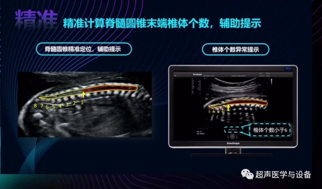 开立超声怎么导出图像借我一双“凤眼”，用AI把产筛纷扰看得真真切切---那个高老师探究彩超功能系列之开立S-Fetus4.0凤眼篇_https://www.jmylbn.com_新闻资讯_第8张