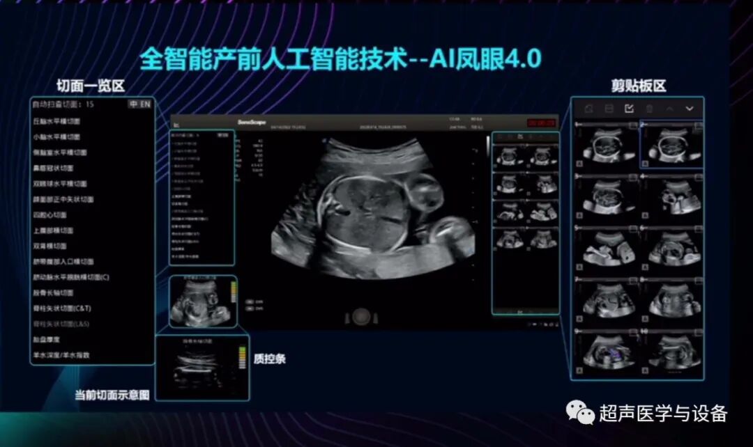 开立超声怎么导出图像借我一双“凤眼”，用AI把产筛纷扰看得真真切切---那个高老师探究彩超功能系列之开立S-Fetus4.0凤眼篇_https://www.jmylbn.com_新闻资讯_第6张