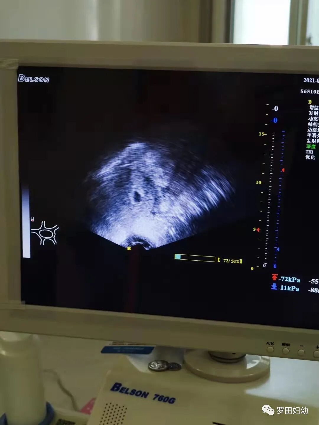 超声引导人流是什么【科普】带您了解“睡一觉”就可完成的无痛人流是怎么进行的。_https://www.jmylbn.com_新闻资讯_第13张