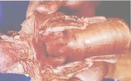 图73坏死性咽炎