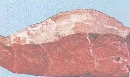 图75出血性肺炎