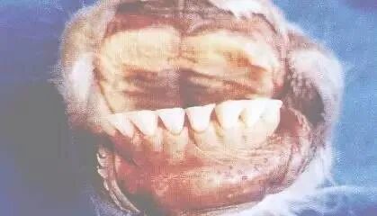 图72坏死性口膜炎