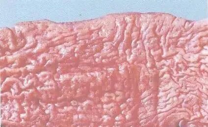 图74坏死性盲肠炎