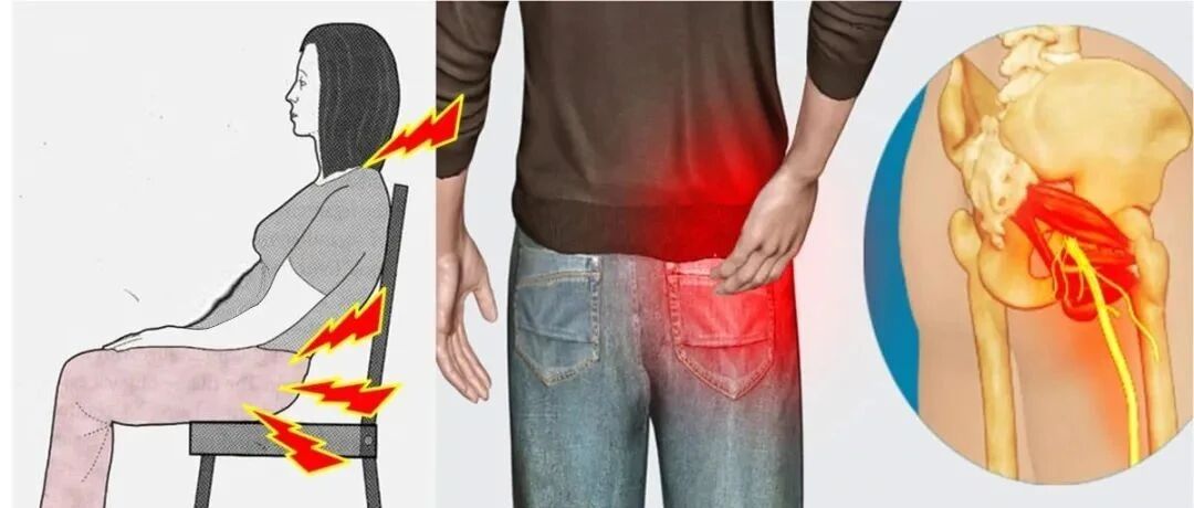 腿麻腰痛，可能被“坐骨神经痛”盯上了