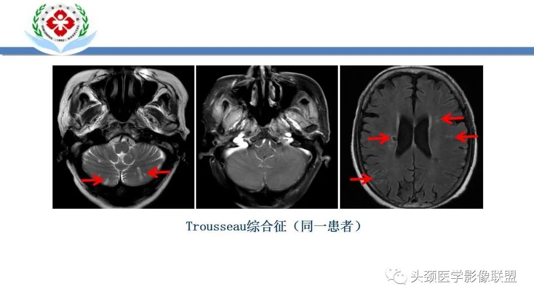 特鲁索综合征（ts)影像诊断