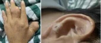 20年老病号一觉醒来脚“被吃了”！防此病，牢记“四低两多两禁忌”