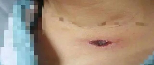 跳广场舞被虫咬，六旬女子病危！眼下仍是虫咬多发季，身上有这种痂千万要注意