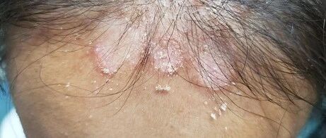 10岁漂亮姑娘额头惊现“梅花斑”……梅雨季，家养宠物者当心得这种病！