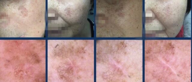 这种“见光死”的红斑竟是常见的癌前病变！专家：发病率可能被低估