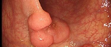 陪老伴看病，顺便做了个检查，结果夫妻双双查出结肠癌，难道癌症也会传染？医生说……