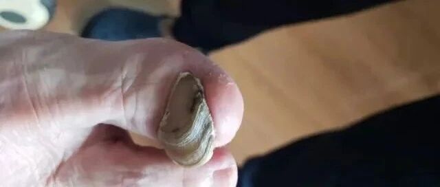 八旬老人脚趾甲似“牡蛎”，挪进诊室时直喊“救救我”！您的指/趾甲有问题，可去这家医院看看！
