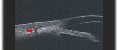 一根3毫米长的刺，让他吃了20多天的苦头！板栗飘香季，这样的病人还挺多