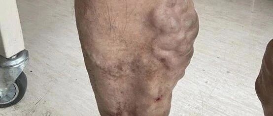 天呐！七旬大伯腿上密密麻麻“爬满了蚯蚓”，又像是腿里塞了棉花，原来是得了这个病！