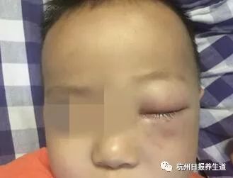 爺爺的一個疏忽，差點毀了2歲寶寶的眼睛！眼科醫生：還有許多「稀奇古怪」的病例 健康 第3張