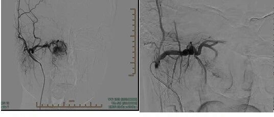 少年反复流鼻血却未深究原因，没想到竟是肿瘤找上门！鼻子出现这些问题赶紧去医院