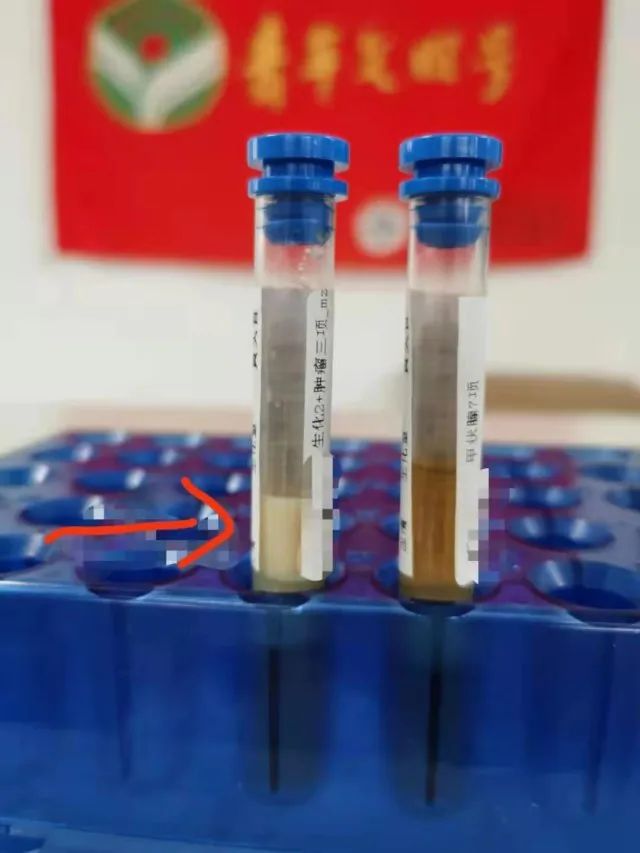 血液变“牛奶”!53岁男子甘油三酯是正常值的63倍,竟是这些习惯害了他……-微信头条网 血液变“牛奶”!53岁男子甘油三酯是正常值的63倍,竟是这些习惯害了他……