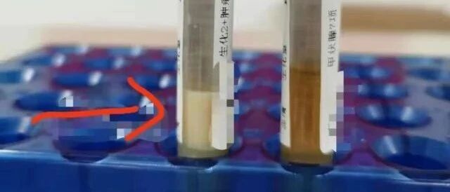 血液变“牛奶”！53岁男子甘油三酯是正常值的63倍，竟是这些习惯害了他……