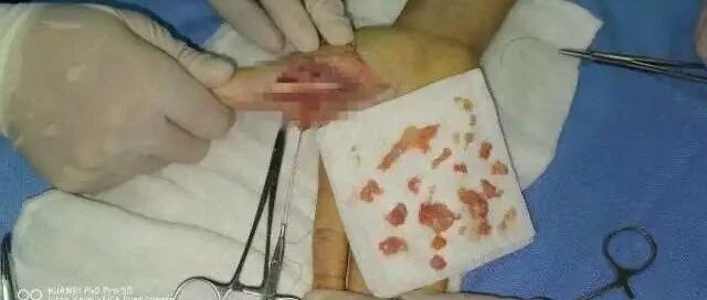 23岁海鲜店主处理海鲜时，一不小心，手指差点截指。海鲜大量上市，处理时千万要小心了