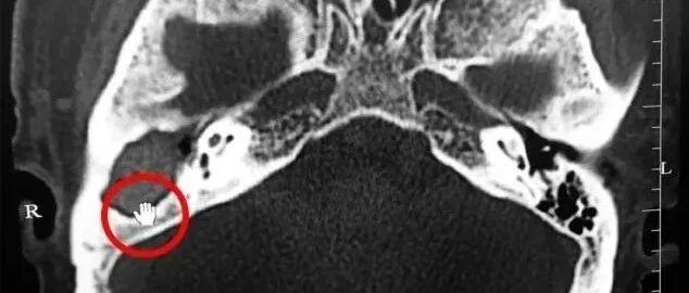 七旬大伯掏耳朵“掏”出肿瘤，还会有生命危险！关于掏耳朵，专家这样说！