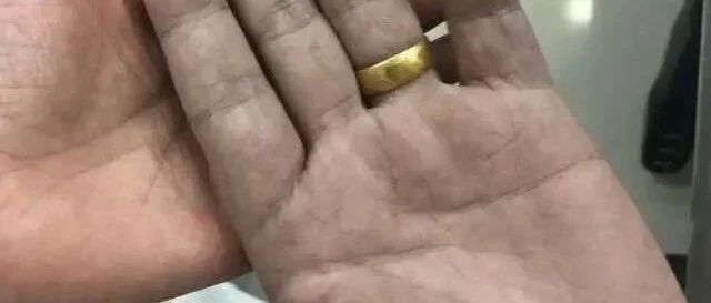 晚饭后性情大变、恶心呕吐、双手发紫！52岁老张的怪病，与一碗传统美食有关