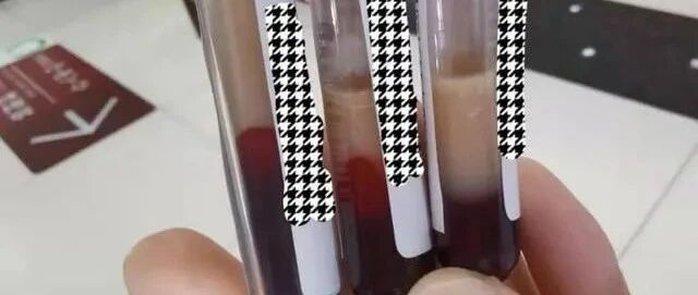 抽血竟然抽出半管脂肪，医生说，幸好及时发现，不然很可能会危及生命