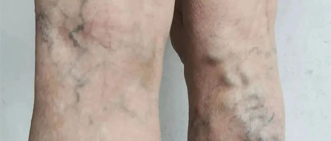 “蚯蚓腿”？杭州一女士被它困扰了十余年！3类人群高发