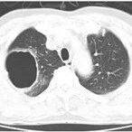 六旬木匠持续高烧后突然咯血，这种“职业病”还是重在预防