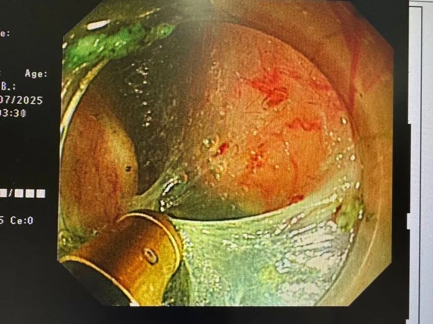 双极刀怎么画黑龙江省医院创新应用双极刀技术为高风险心动过缓患者完成高难度食管肌瘤内镜隧道法切除术_https://www.jmylbn.com_新闻资讯_第2张