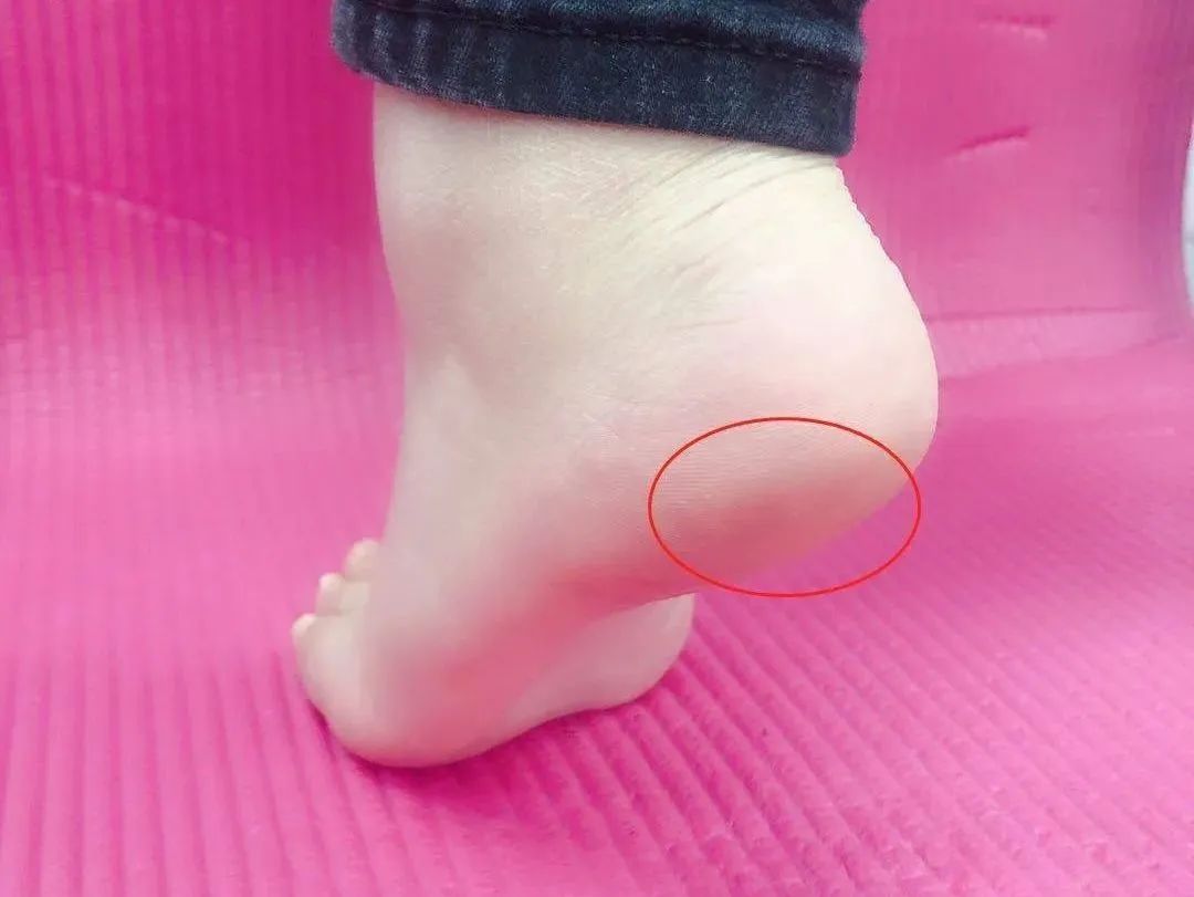 脚后跟疼痛是什么原因？五种情况，你有吗？