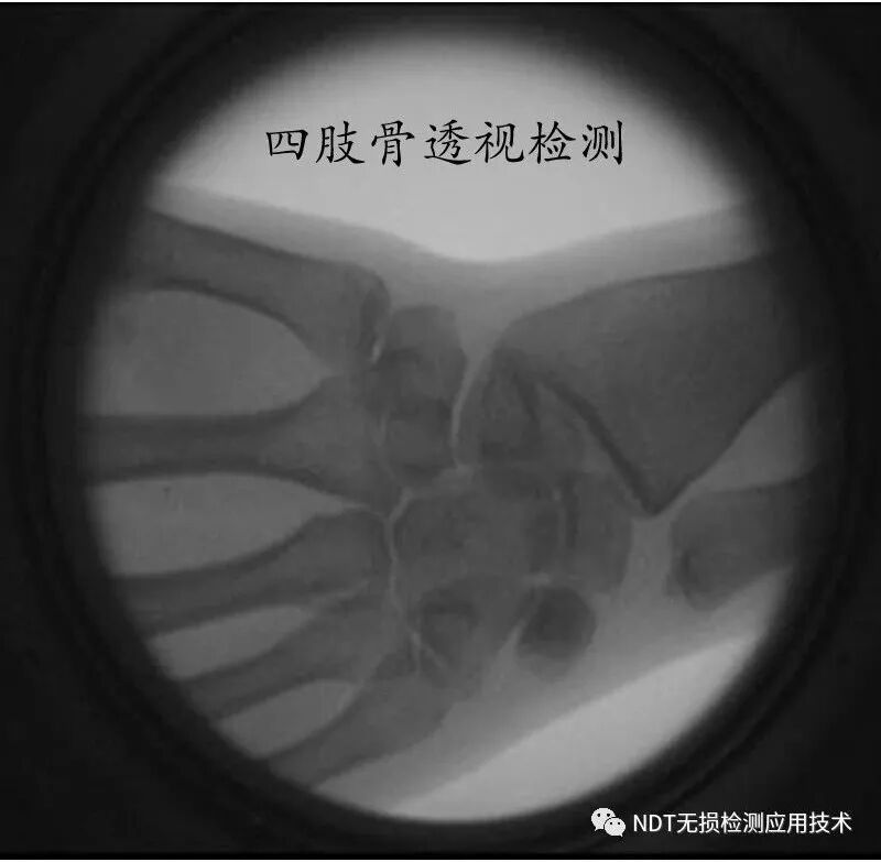 为什么x光片用胶片传统X光胶片成像和X射线数字成像的区别_https://www.jmylbn.com_新闻资讯_第1张