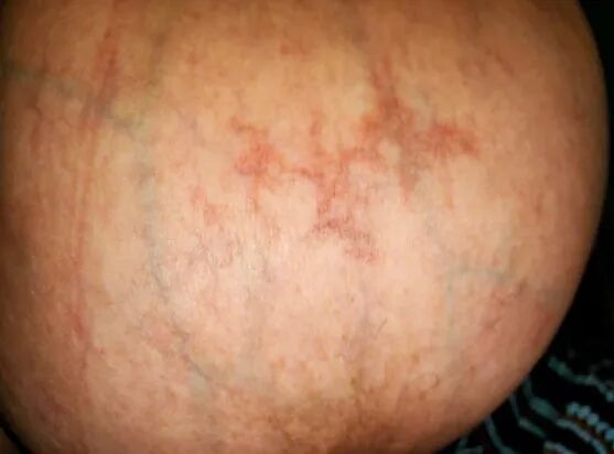胸部网状红斑会是什么病看图诊断