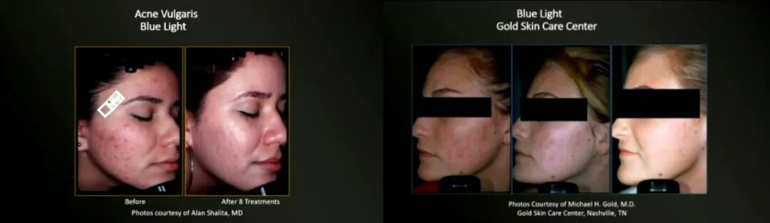 4006B光疗怎么用46%的痤疮患者对现有疗法不满，激光与光疗如何发挥作用？_https://www.jmylbn.com_新闻资讯_第2张