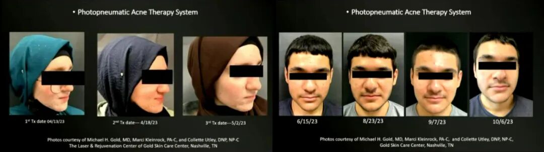 4006B光疗怎么用46%的痤疮患者对现有疗法不满，激光与光疗如何发挥作用？_https://www.jmylbn.com_新闻资讯_第3张