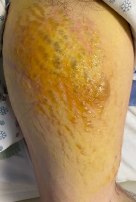 皮肌炎患者的大疱性皮疹与什么因素有关看图诊断