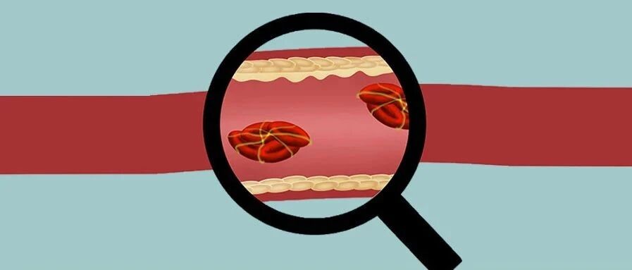 血管粗不会得血栓？形成的血栓要素是什么？