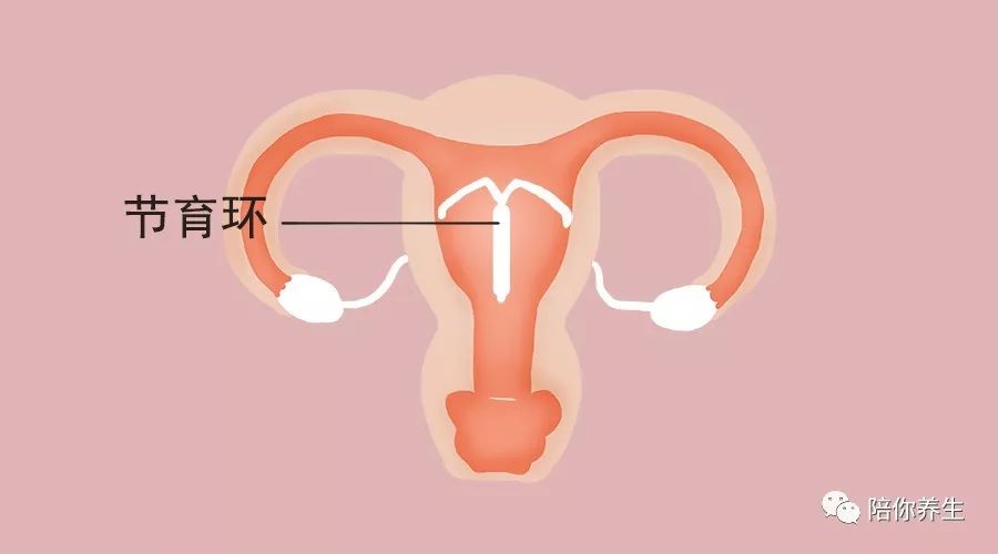 絕經之後 節育環要取出來嗎 大多數女人都不知道 健康 第2張