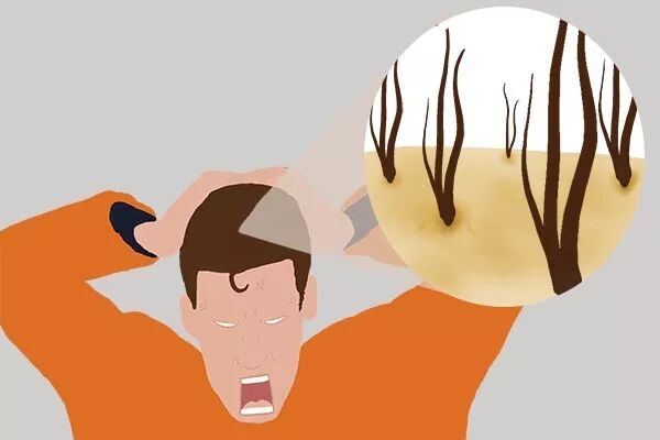 头皮上，为何能摸到硬硬的小疙瘩，还一抠就破？