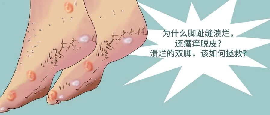 为什么脚趾缝溃烂，还瘙痒脱皮？该如何拯救？