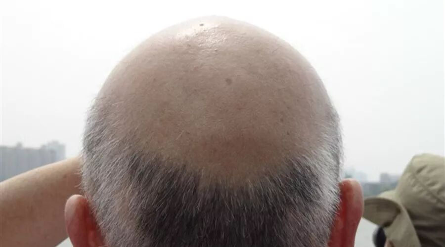 为什么一到中年就遭遇脱发危机？