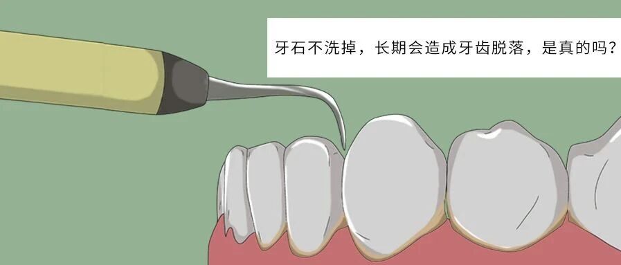 牙石不洗掉，长期会造成牙齿脱落，是真的吗？
